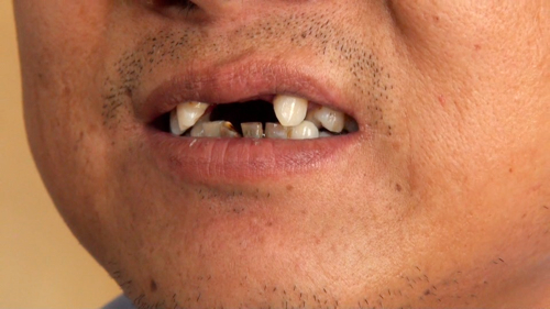 歯が抜けた訴える打拉亥村の男性 （2013年5月22日）